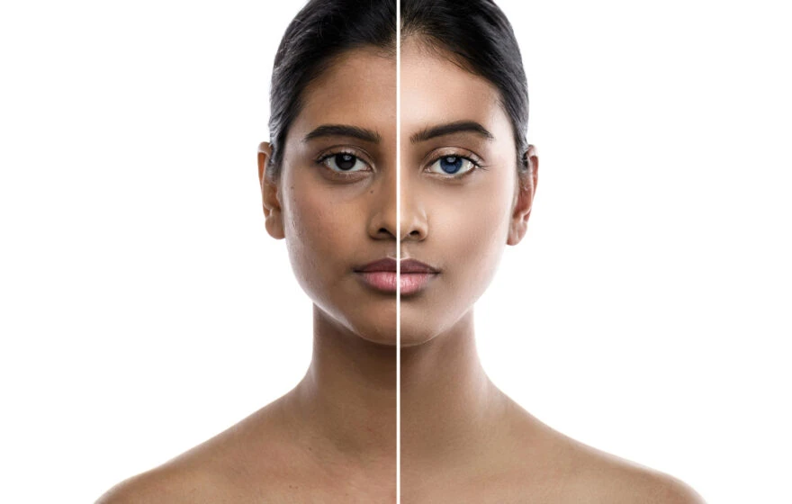 A portrait of a woman's face divided down the middle; the left side shows uneven skin tone and dark circles, while the right reveals smooth, even-toned skin after using reduced glutathione for skin whitening.