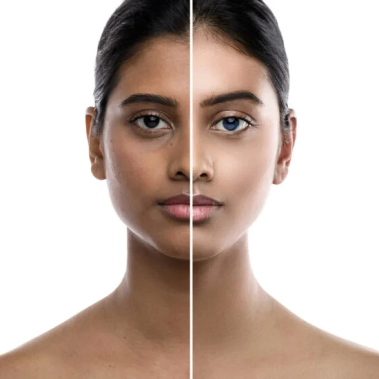 A portrait of a woman's face divided down the middle; the left side shows uneven skin tone and dark circles, while the right reveals smooth, even-toned skin after using reduced glutathione for skin whitening.
